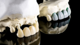 How to Clean Black Stains on Dentures: Removing Black Stains with Care