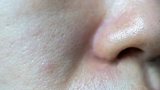 How To Get Rid of Open Pores Naturally at Home?
