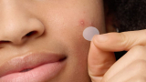 How to Put on Pimple Patches: Patch It Up